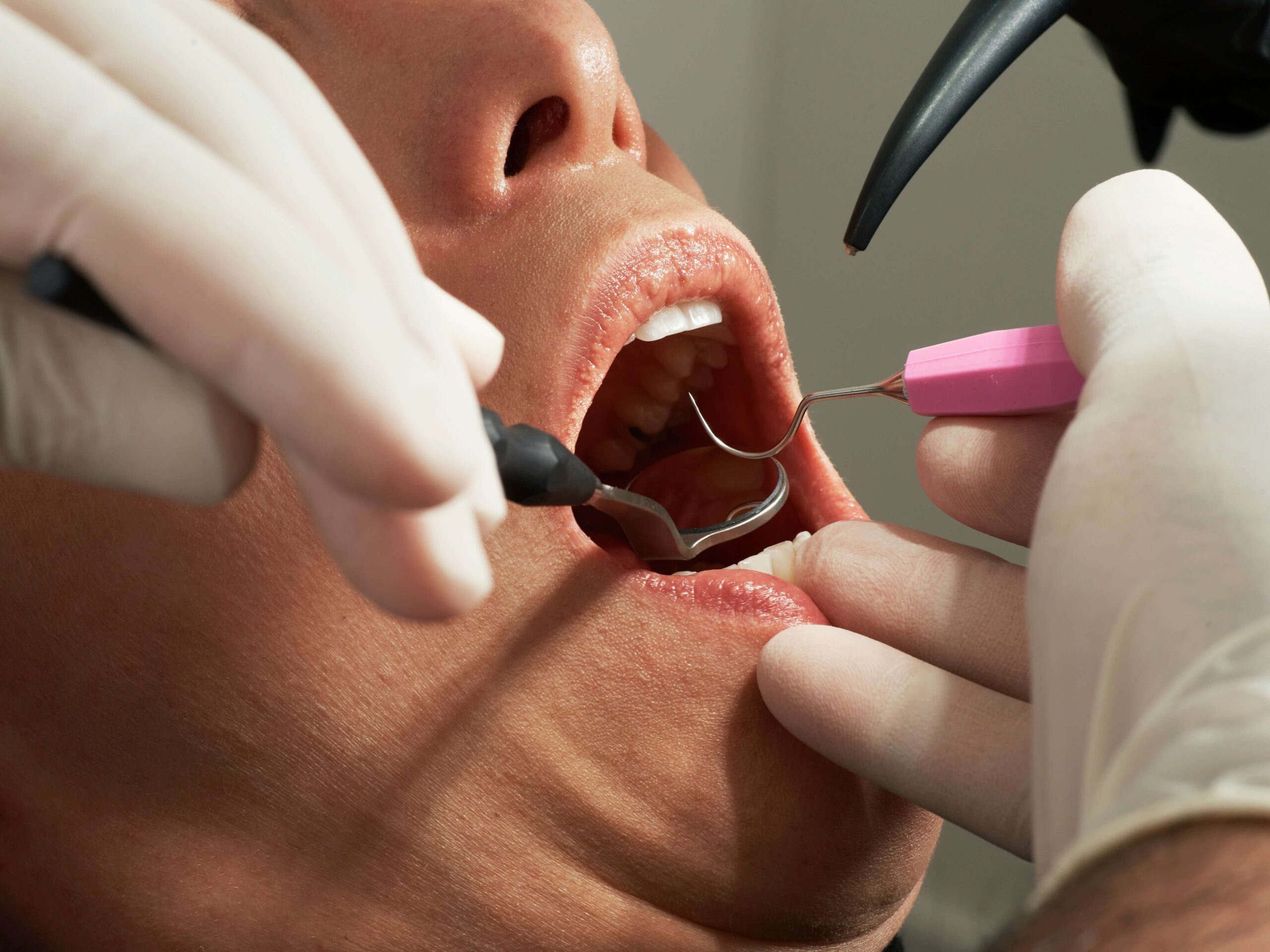 Primer plano de un tratamiento dental con instrumentos odontológicos en boca de paciente