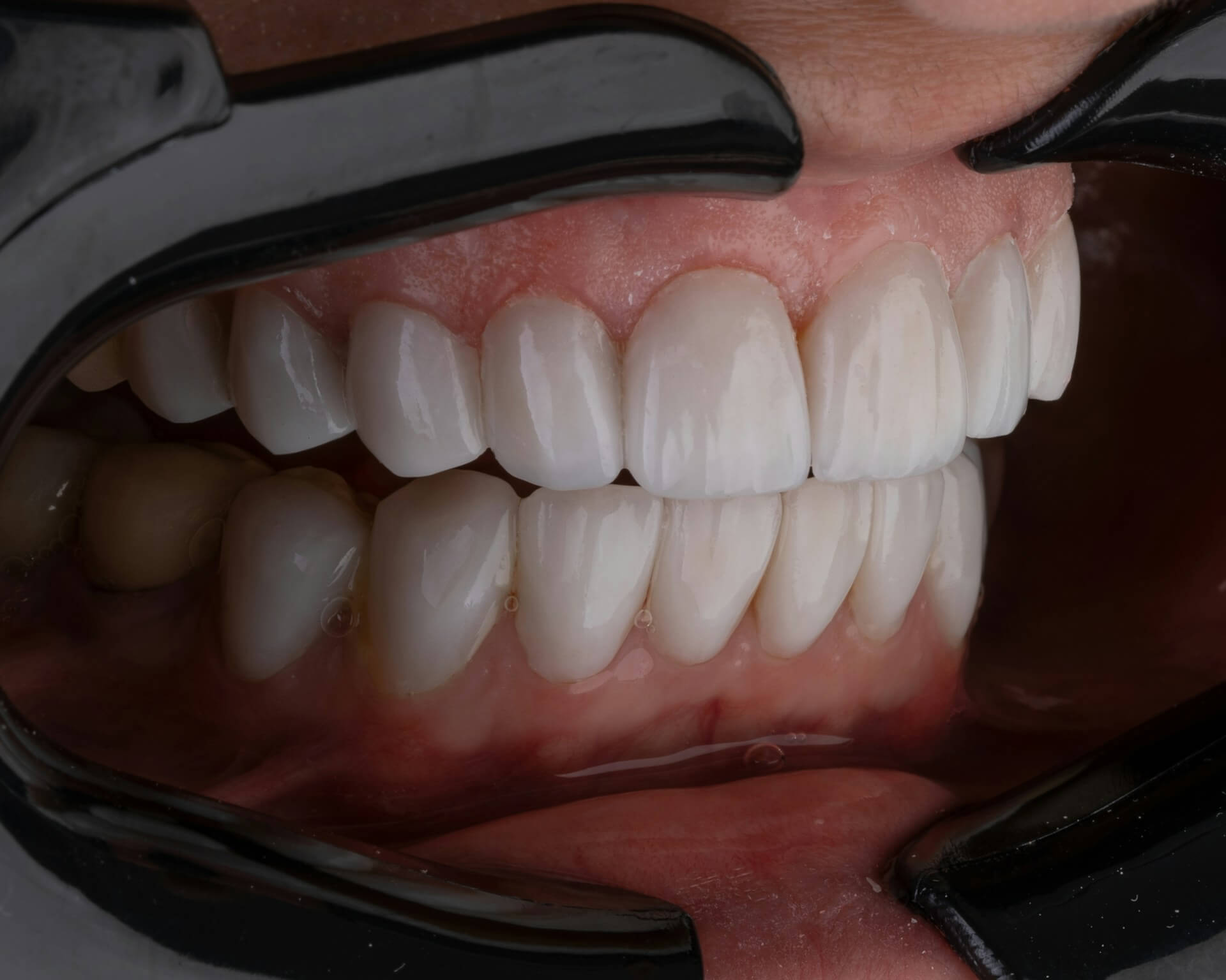 Periodoncia con boca abierta mostrando encias.