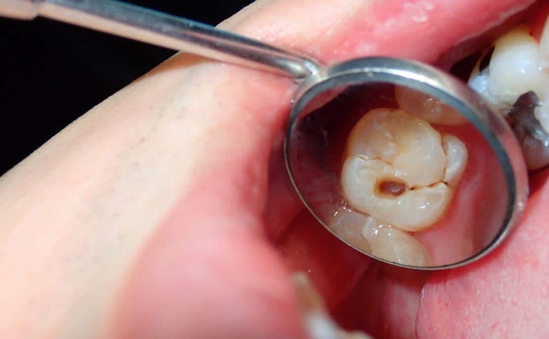 endodoncia en sevilla