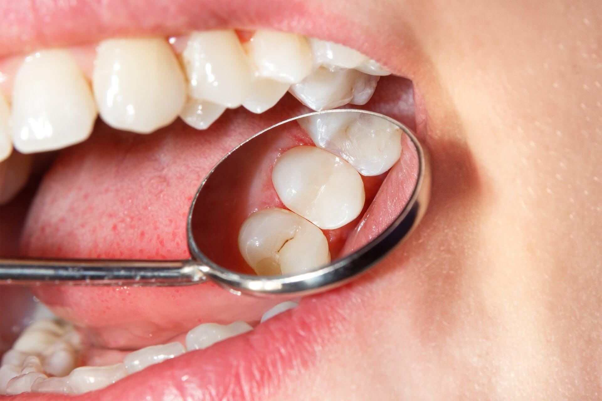 Casos de caries para empaste dental