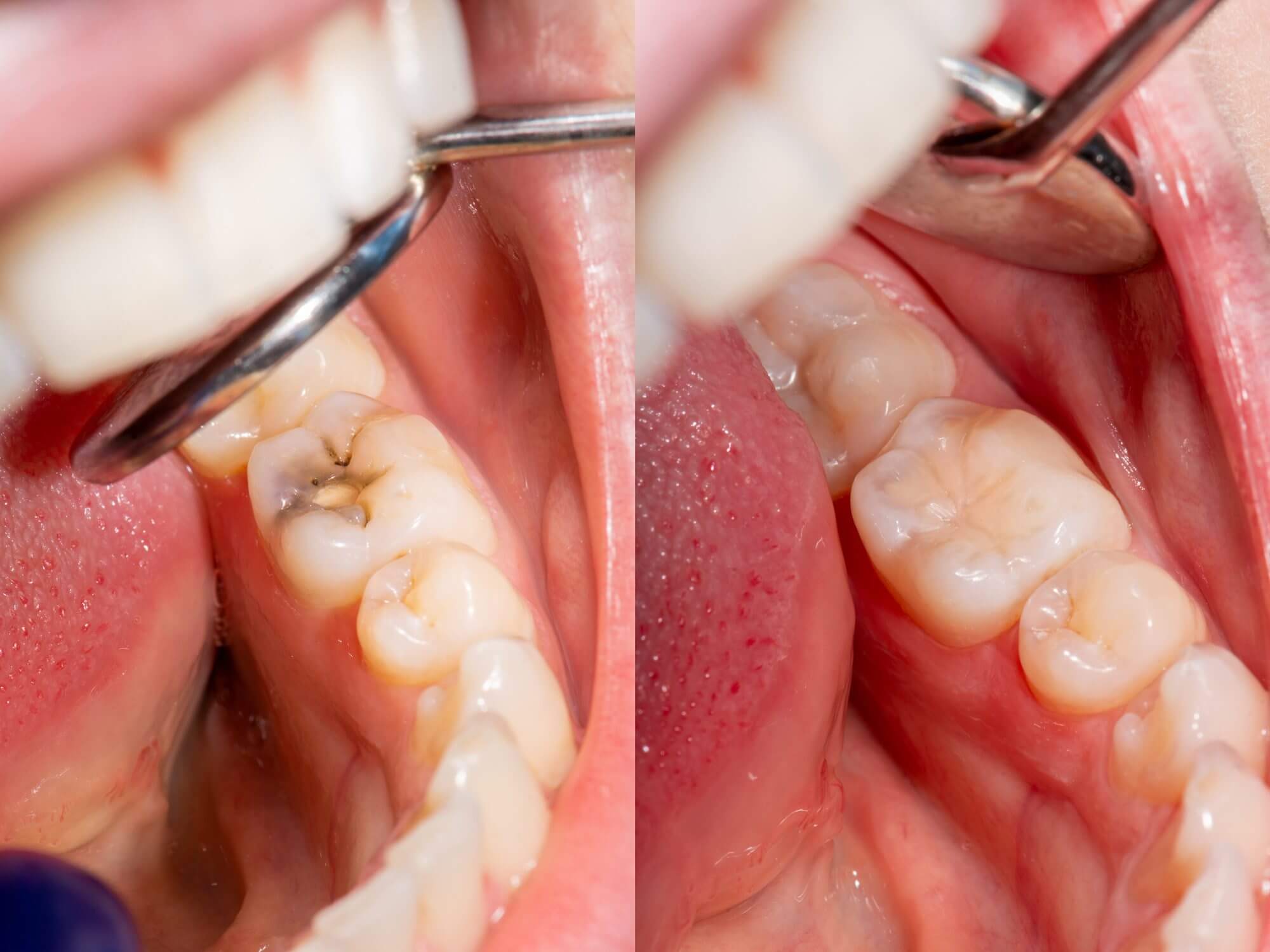 antes y despues empastes dentales